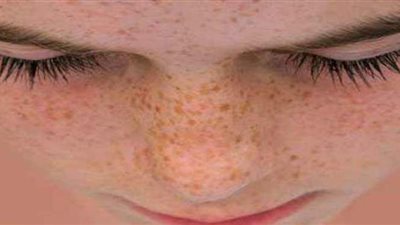 وصفات طبيعية للتخلص من النمش نهائيا