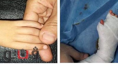 إنجاز طبي جديد بمستشفيات طنطا الجامعية.. تحويل السبابة إلى إبهام بيد طفل عمره عامان