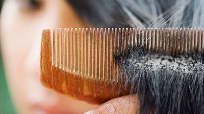 الطعام سبب رئيسي لقشرة الشعر