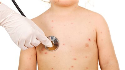 «شبح» الجدري يثير الرعب بمدرسة الراعي الصالح ببورفؤاد.. أولياء الأمور: المرض تفشى بين الطلاب ووصل لأعضاء هيئة التدريس.. إدارة المدرسة تطالب بإحضار ديتول ومناديل مبللة مع الطلاب لتطهير المدرس