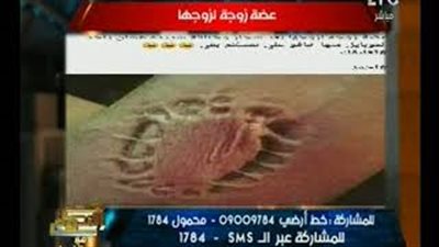 سيدة تعض يد زوجها وتنشر الصورة عبر «فيس بوك» (فيديو)