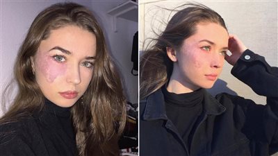 وحمة في وجه فتاة شابة تثير ضجة عبر إنستجرام (صور)