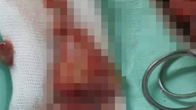 استئصال ورم من مخ سيدة في مستشفى المنشاوي العام بطنطا