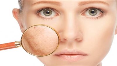 أسهل طريقة طبيعية للتخلص من الكلف في أسبوع