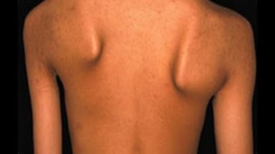 6 أعراض لمرض وهن العضلات تظهر بشكل مفاجئ