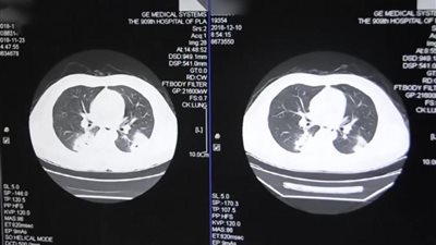 «شم الجورب» كل يوم يصيب رجلا بعدوى شديدة في الرئة (صور)