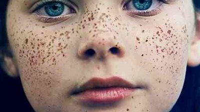 3 ماسكات فرنسية للتخلص من النمش نهائيا