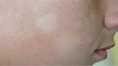 أسباب مرض النخالة البيضاء وطرق الوقاية