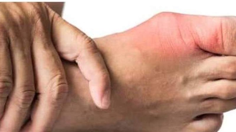 مرض النقرس