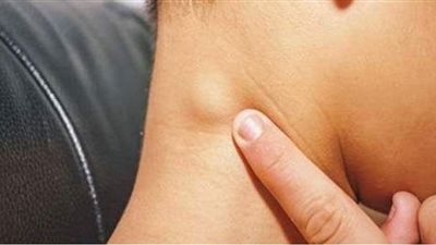 أسباب تضخم الغدد الليمفاوية