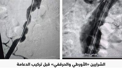 نجاح أول عملية علاج الصمام الأورطي بتقنية CERAB في الأقصر