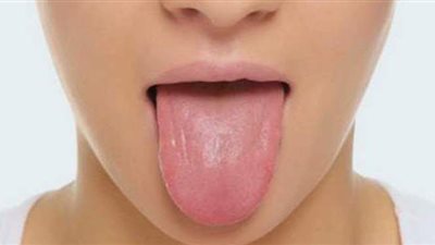 طرق طبيعية لعلاج فطريات اللسان