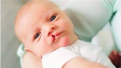 استشاري: علاج الشفة الأرنبية يحل مشكلات كثيرة عند المصابين بها