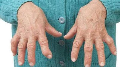 أعراض مرض الروماتويد