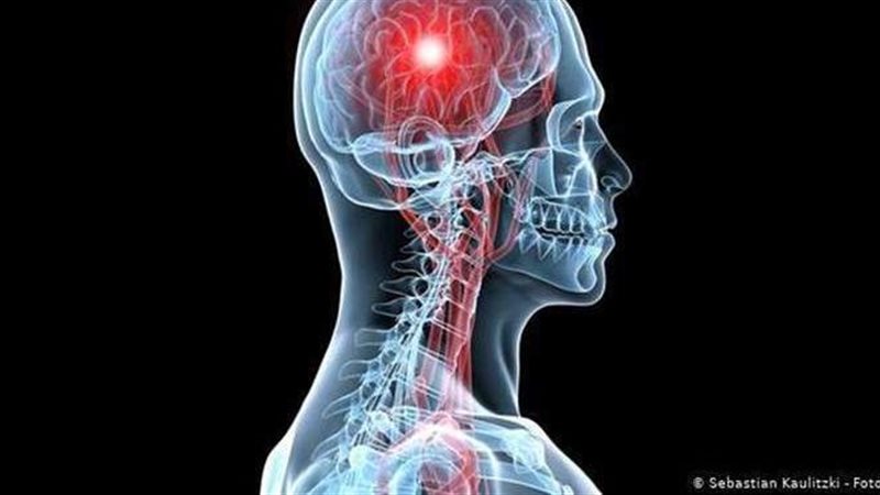 أعراض الجلطة الدماغية