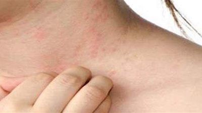 تعرفي على أسباب ظهور حمو النيل وطرق العلاج