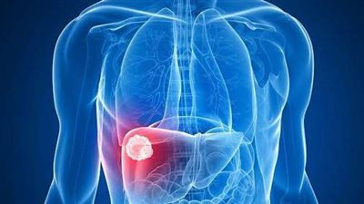 أطباء: مزج العلاج المناعي بالموجه يقضي على سرطان الكبد والكلى