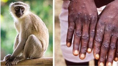 بعد ظهورها في الصين.. اكتشاف حالة جدري القردة في ولاية أمريكية