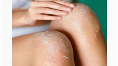 اصنعي بنفسك قناع فيتامين C للحصول على «ركبة» ناصعة البياض