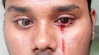 رجل يبكي دما يحير الأطباء بالهند