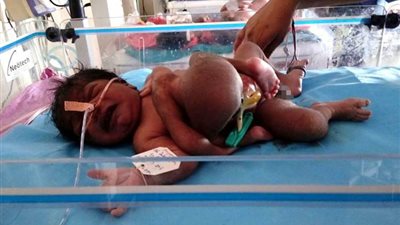 بالصورة.. ولادة نادرة لطفل بتوءم طفيلى ملتصق ببطنه