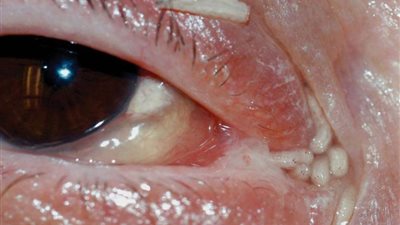 بالفيديو والصور.. إزالة 120 يرقة من أنف وعين امرأة