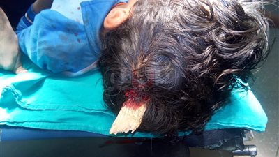 أطباء «الأقصر الدولي» ينقذون طفلا اخترقت خشبة رأسه