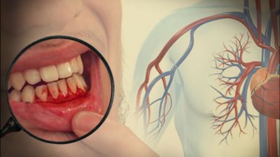 4 خطوات طبيعية لعلاج التهابات اللثة بالمنزل