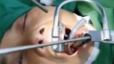 لقطات مقززة لاستئصال دودة حية من حلق امرأة طولها 2 بوصة (فيديو)