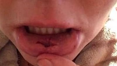 غيرت صورتها الشخصية بـ«فيس بوك» فحطم حبيبها وجهها (صور)