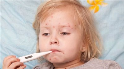 «الجديري المائي» يهدد 300 تلميذ وتلميذة ببني سويف