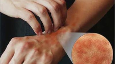 تعرفى على طرق علاج حساسية الجلد