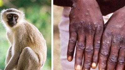 ينتشر في 11 دولة أفريقية.. الصحة الأمريكية تكشف مخاطر جدري القرود على البشر