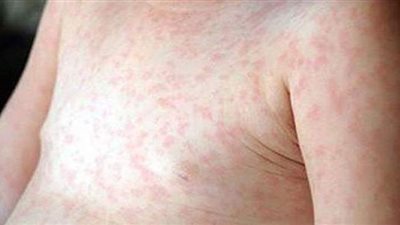 أعراض الحمى الوردية والأسباب وطرق العلاج