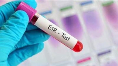 ما هو تحليل سرعة الترسيب ESR؟