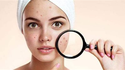 7 أصناف من الأعشاب الطبيعية تقضي على حب الشباب