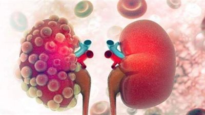 7 فئات معرضة للإصابة بالفشل الكلوي