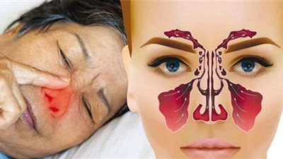 علاج الجيوب الأنفية بالأعشاب