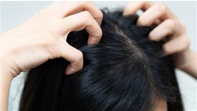 10 أسباب لحكة الرأس ونصائح للتخلص منها