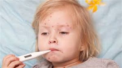 الجديري المائي يهاجم مدارس دمياط الجديدة ويصيب 20 تلميذًا