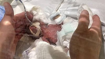ولادة أصغر طفل في العالم بوزن أقل من قالب زبدة (فيديو)