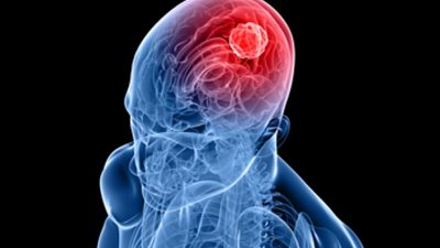 5 عوامل تؤدي إلى الإصابة «بسرطان الدماغ».. احذروها