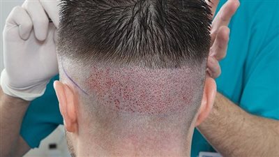 كيفية اختيار أفضل مركز لإجراء عملية زراعة الشعر في تركيا