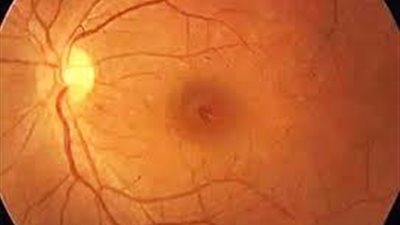 بسبب إهمال طبي.. طفل يفقد بصره داخل مستشفى حكومي بالبساتين