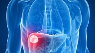 الصين تطور شبكة عصبية تتعلم ذاتيا تساعد في تشخيص وعلاج سرطان الكبد