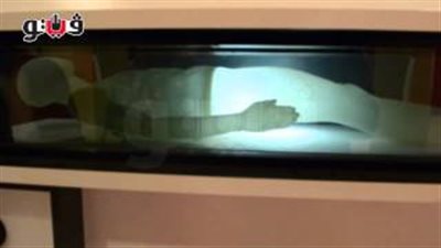 بالفيديو.. تفجير الخلايا السرطانية داخل جسم الإنسان بالذهب