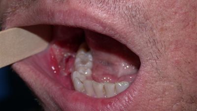 استاذ طب أسنان: التعرض لاشعة الشمس والتدخين يسببان سرطان الفم