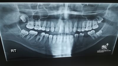 إجراء عملية تثبيت الفك السفلي لمريض تعرض لحادث مروري في بنها