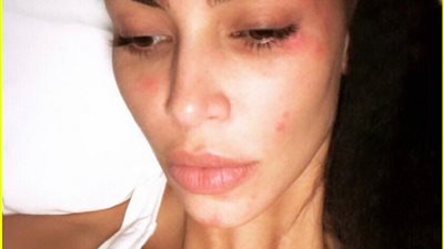 كيم كارداشيان تعبر عن معاناتها مع مرض الصدفية بصورة جديدة