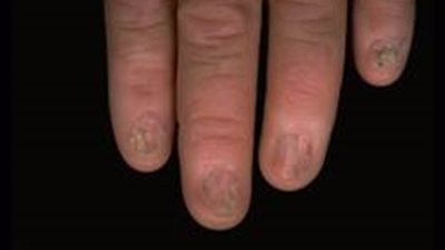 إهمال مريض «الجذام» يؤدي لضمور الأطراف وتآكلها